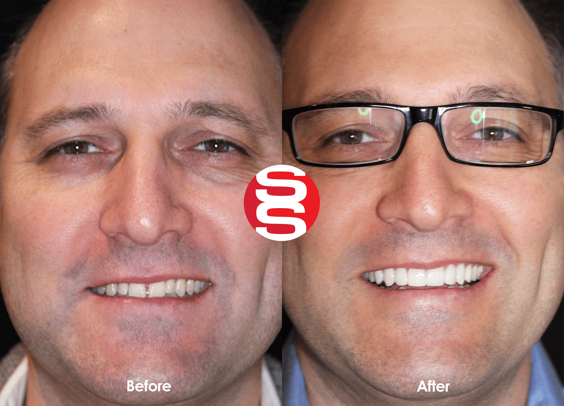 Implants + Porcelain Veneers